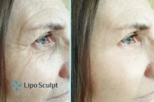 How to Fight Aging Symptoms 2 Do you want to Fight Aging Symptoms Woking? Contact Lipo Sculpt today!