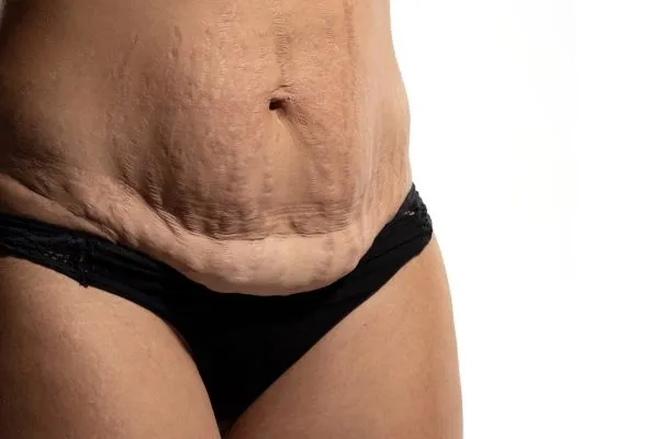 Lost the Weight but Not the Loose Skin? 1 image of womans stomach after weight loss showing loose skin Woking